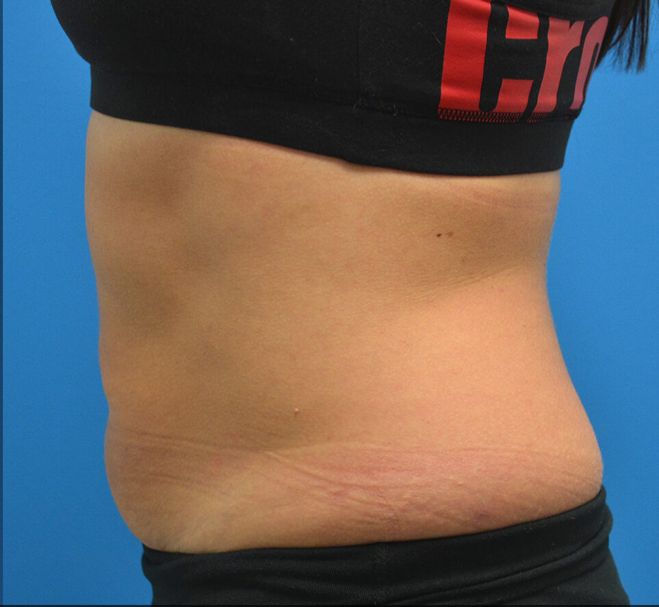 A female's stomach and back after 2 series of SculpSure treatments