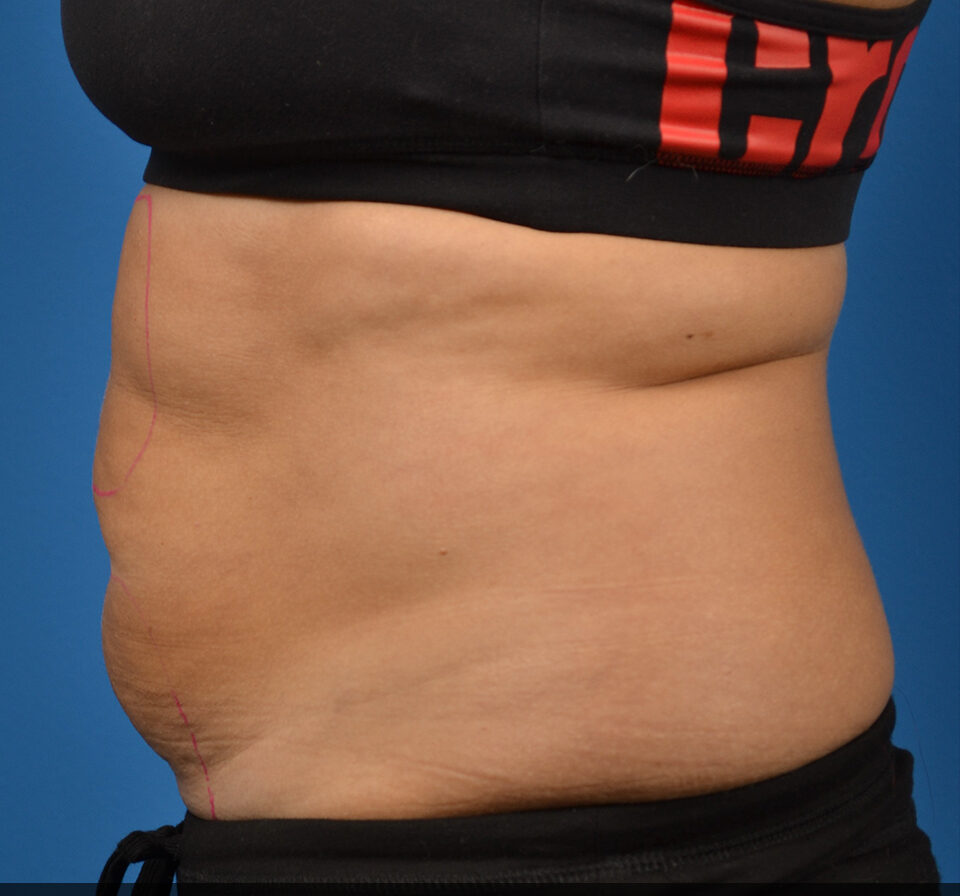A female's stomach before 2 series of SculpSure treatments