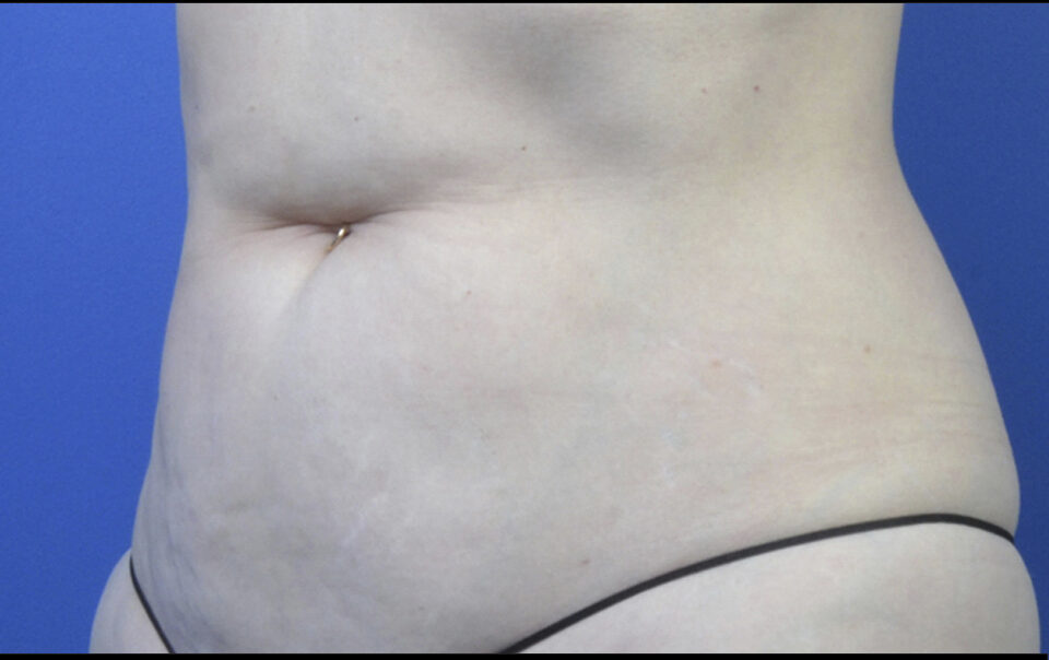 A woman's stomach showing the one year after second SculpSure series