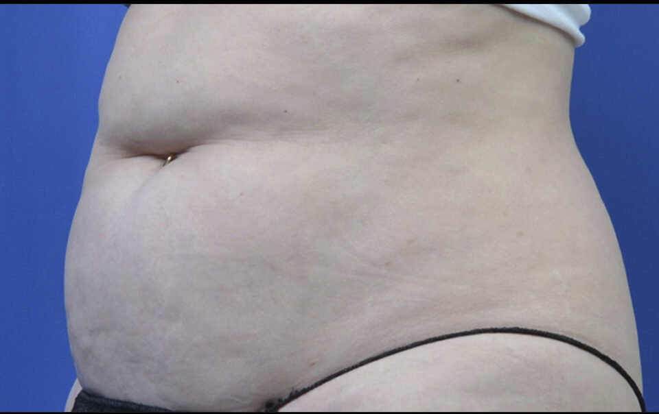 A woman's stomach showing the before SculpSure treatment