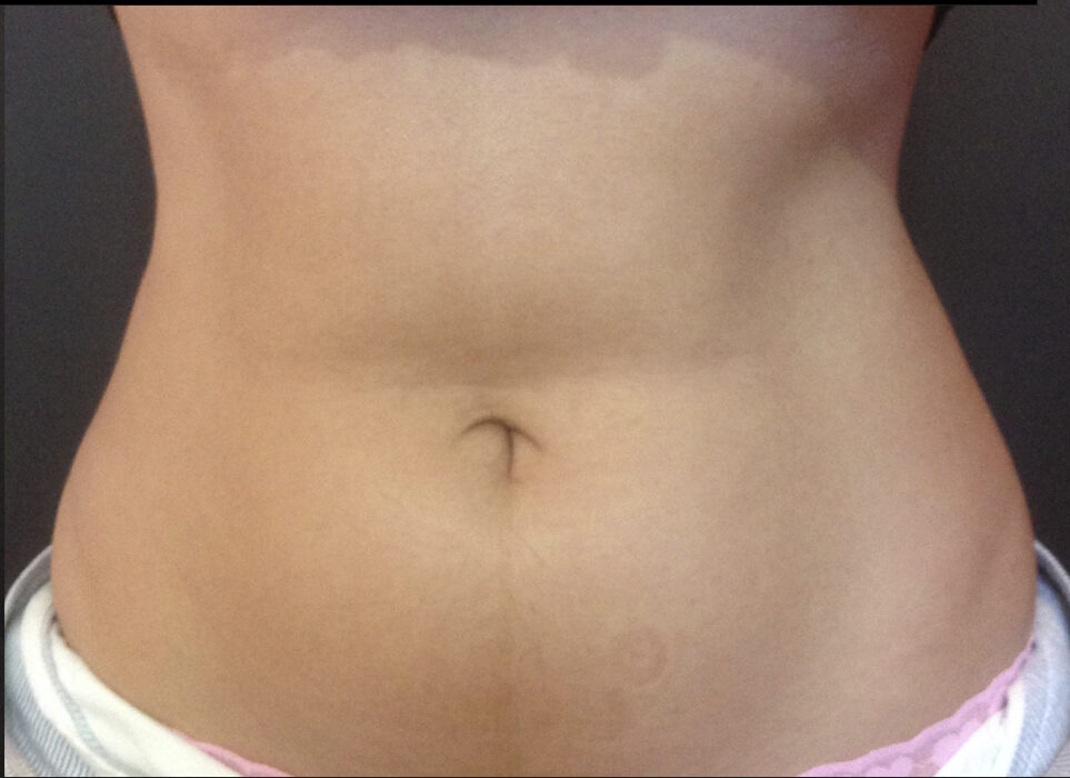A woman's stomach six weeks after second SculpSure treatment series