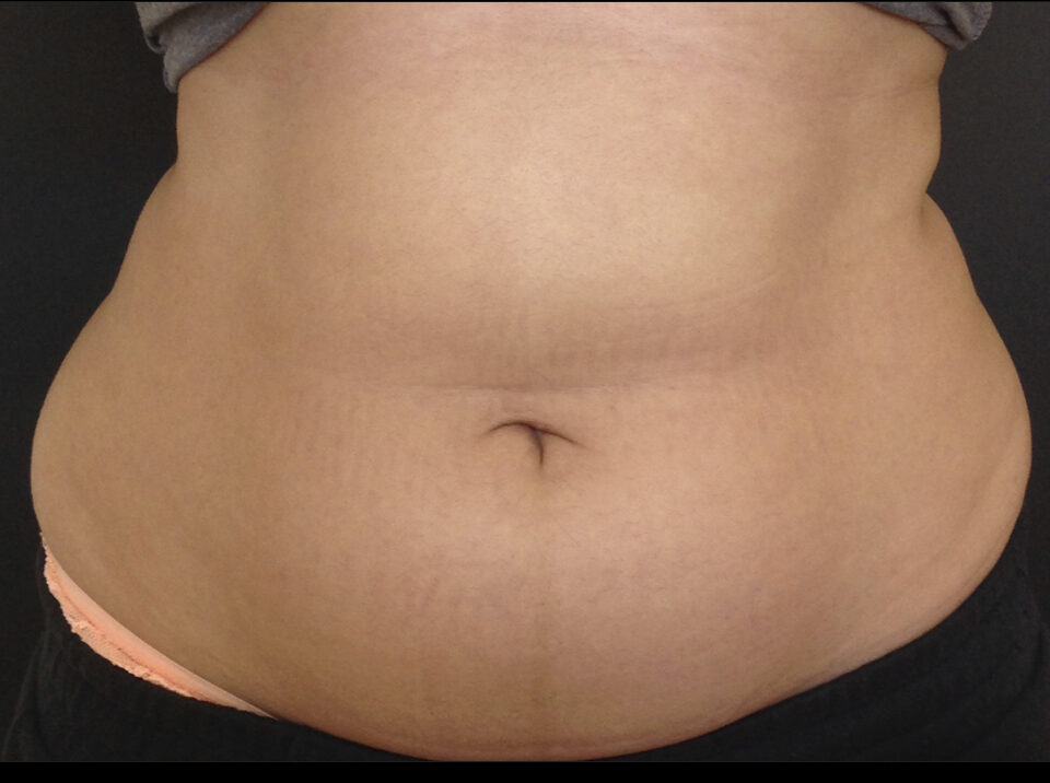 A woman's stomach before the SculpSure treatment series