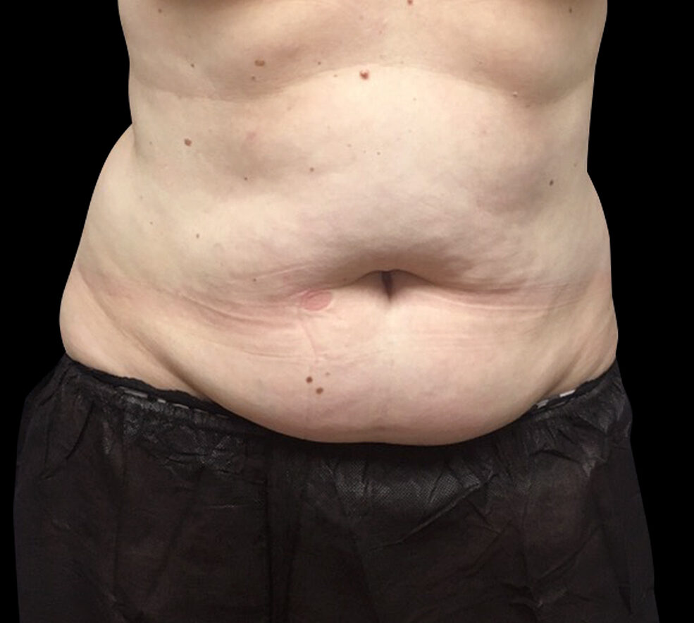 A woman's stomach before SculpSure treatment series