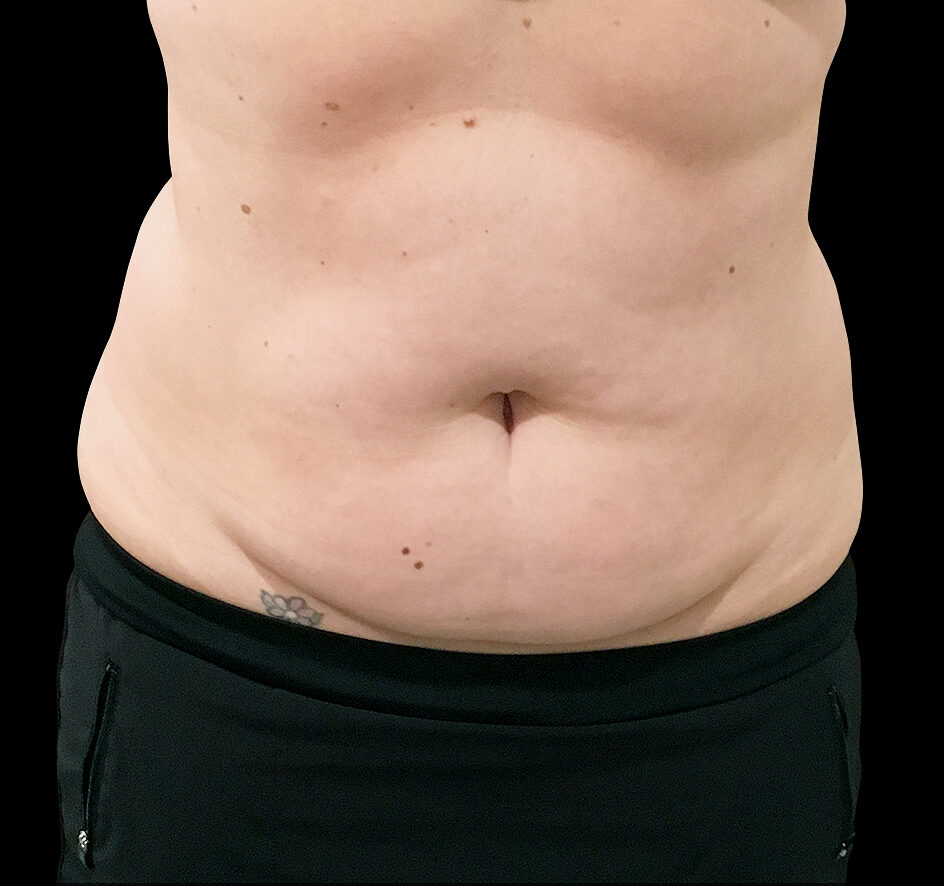 A woman's stomach 12 weeks after second SculpSure series