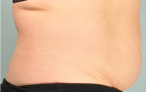A profile of a woman's stomach showing after the SculpSure treatment