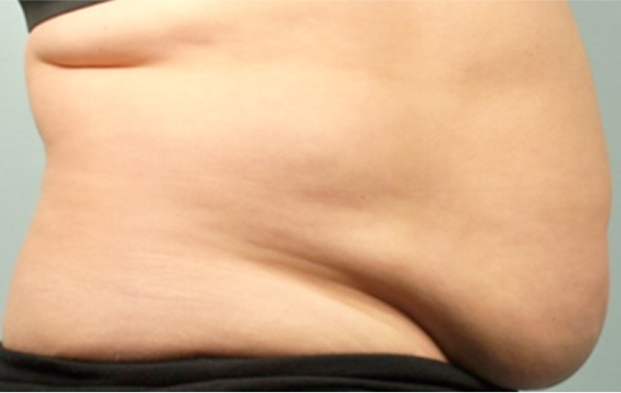 A profile of a woman's stomach showing before the SculpSure treatment