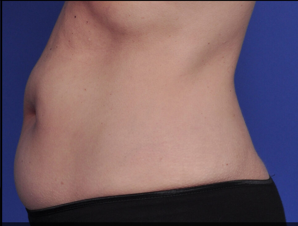 A female's stomach after 2 series of SculpSure treatments