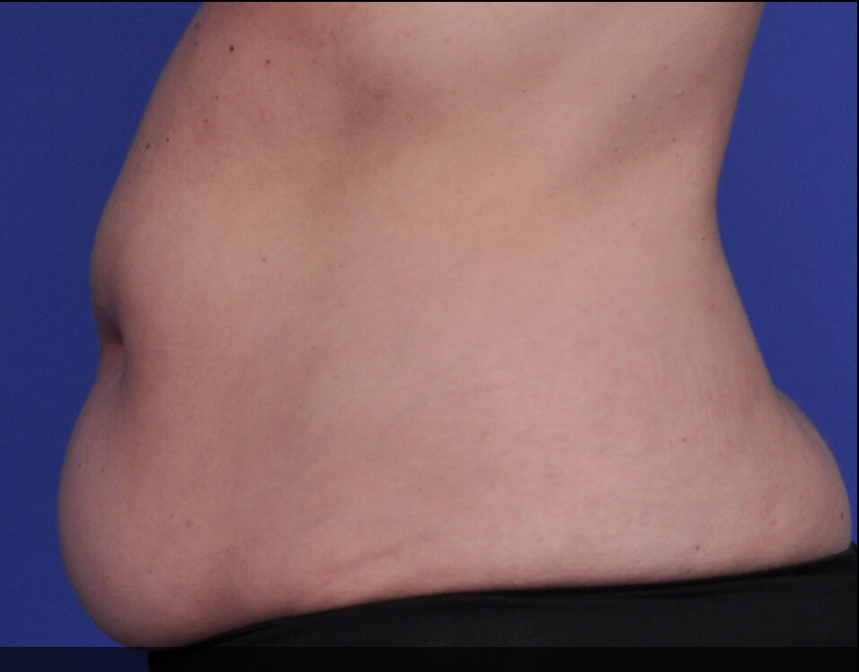 A female's stomach before 2 series of SculpSure treatments
