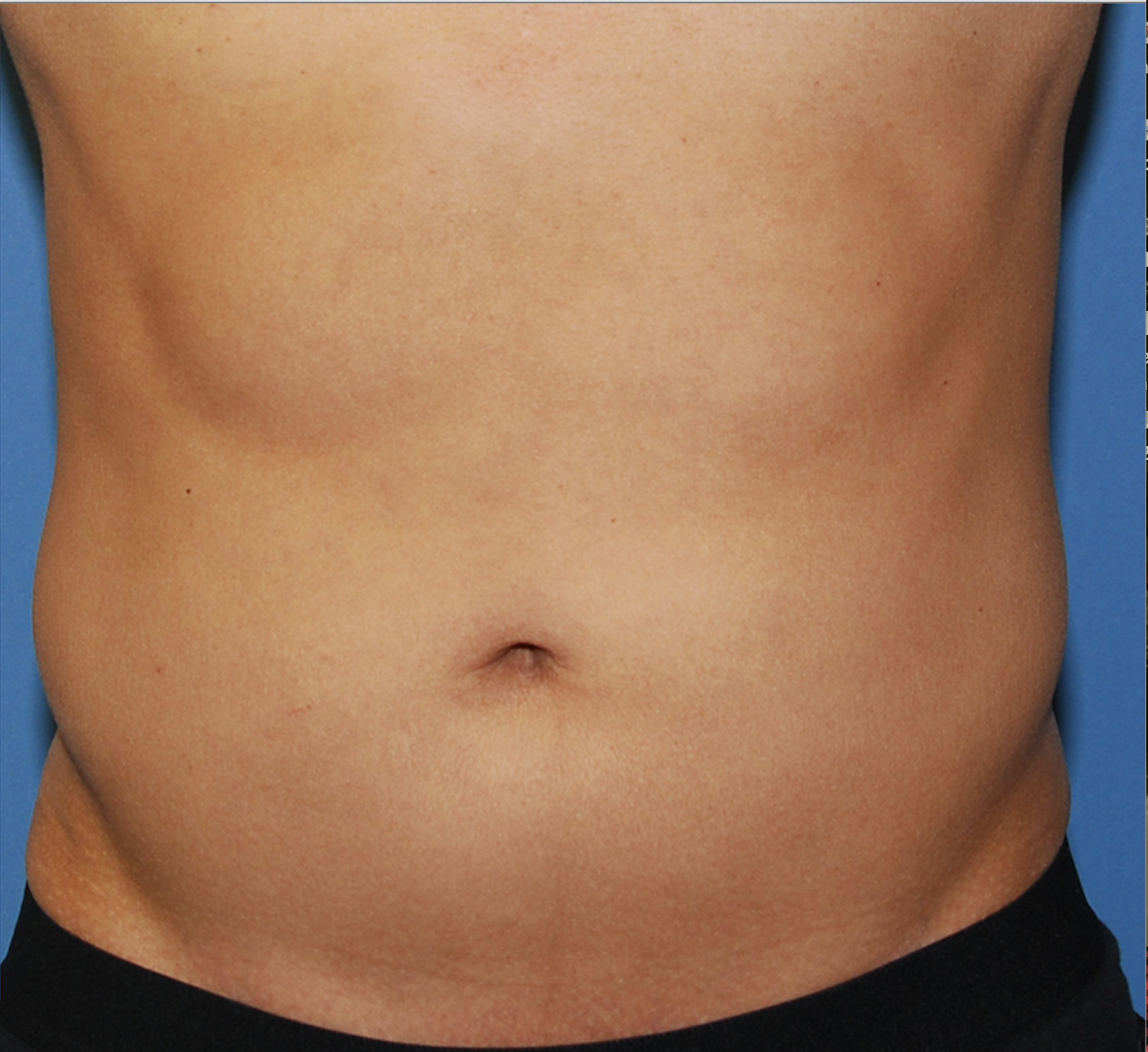 A male's stomach showing results after 2 series of SculpSure treatments