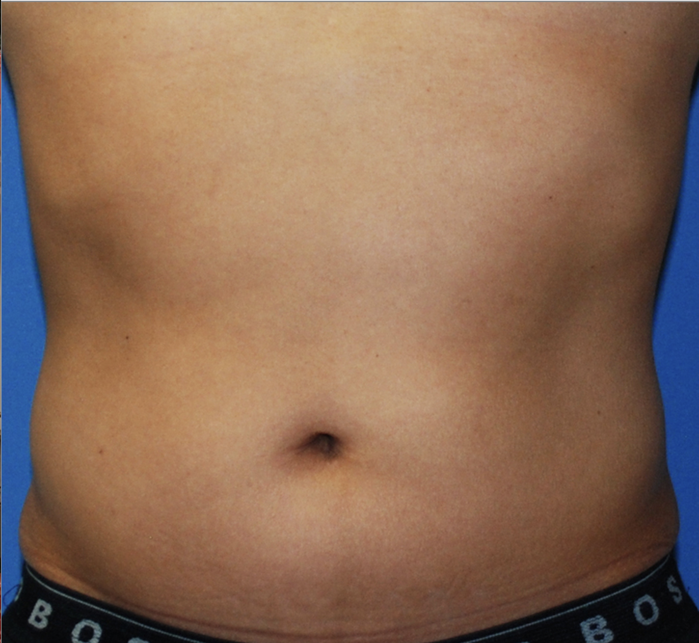 A male's stomach before 2 series of SculpSure treatments