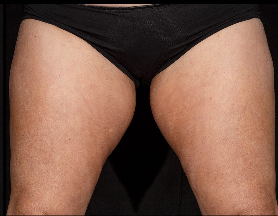 A female's inner thighs after 1 series of SculpSure treatments