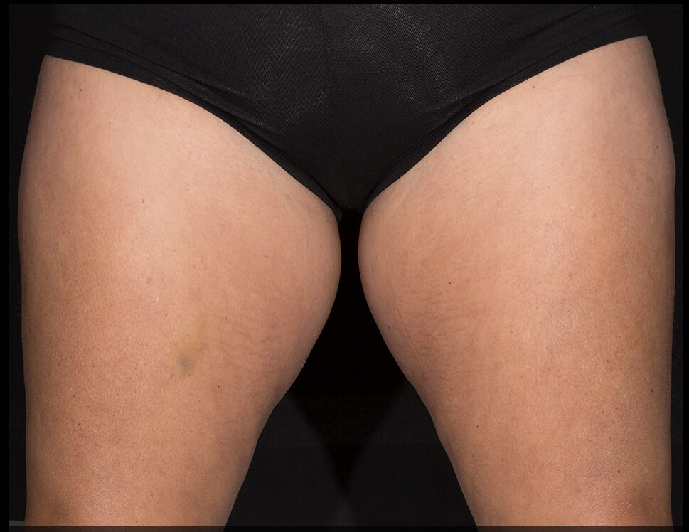 A female's inner thighs before 1 series of SculpSure treatments